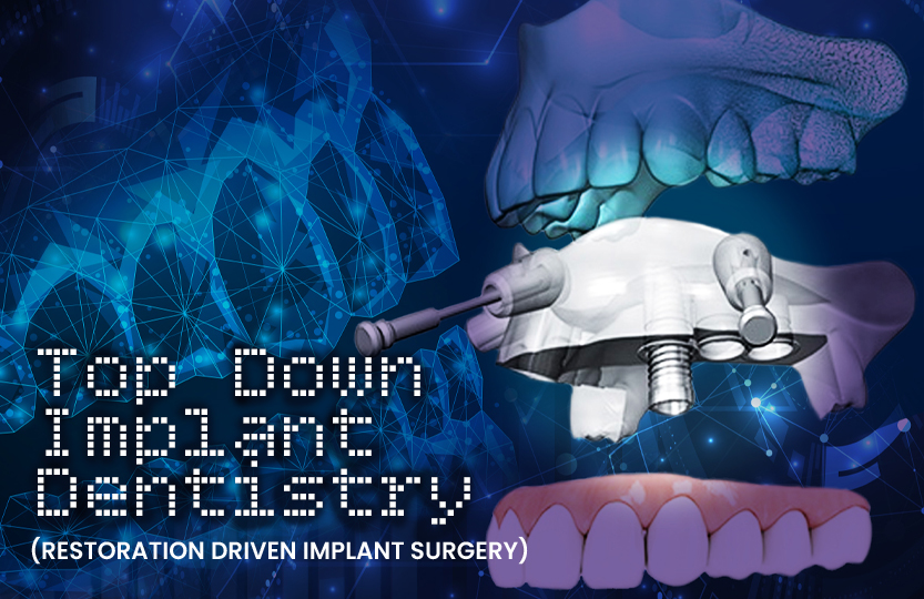 topdown implant