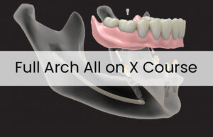 Full Arch  All-on-X @ TJ