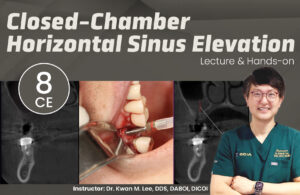 Horizontal Sinus Elevation